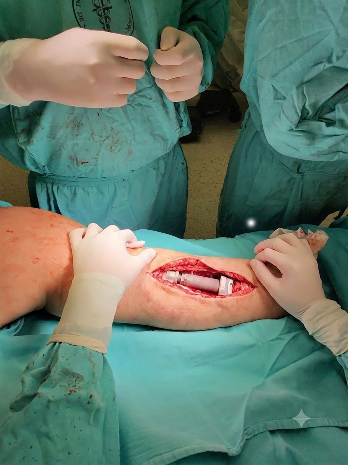 INCan líder en cirugía oncológica de preservación de extremidades para pacientes con sarcomas óseos